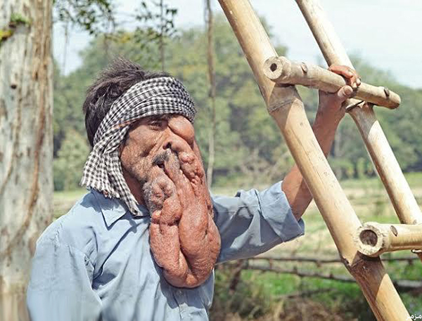 ورم يحول وجه رجل كالفيل(صور)