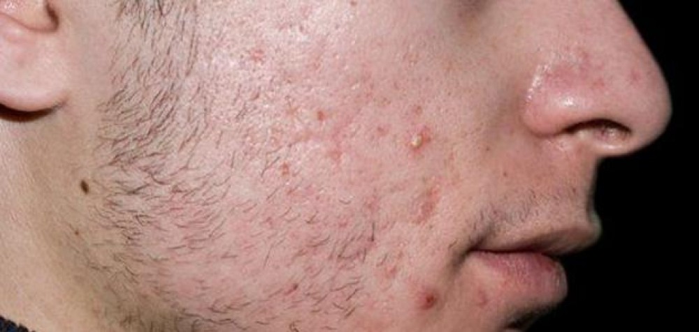 6 مشكلات شائعة تصيب اللحية.. منها ظهور قشرة الرأس والحكة