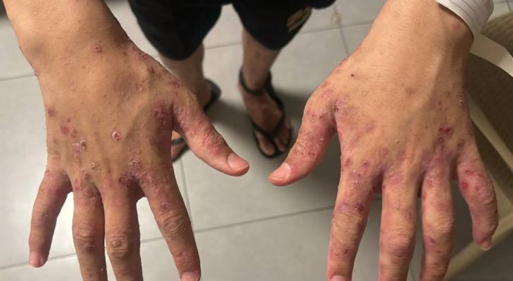 وزارة الأسرى تحذر من خطورة تفشي مرض الجرب بين  أسرى سجن النقب