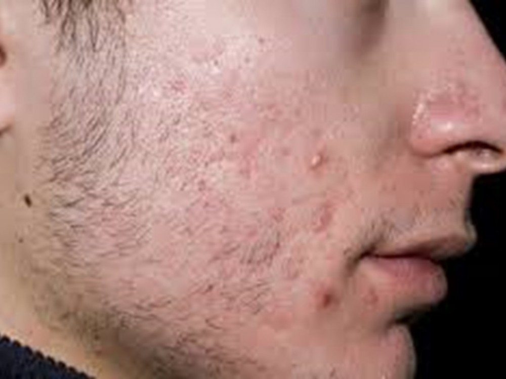 تعرف على طرق الوقاية من بثور الوجه.. اعرف أنواعها