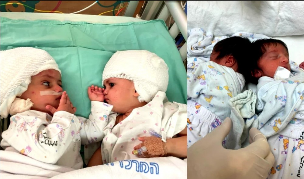 نجاح عملية فصل توأم سيامي ملتصقتين برأسيهما ولدتا لعائلة فلسطينية