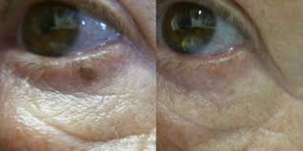 هل من الآمن التخلص من الشامات الجلدية بالليزر؟