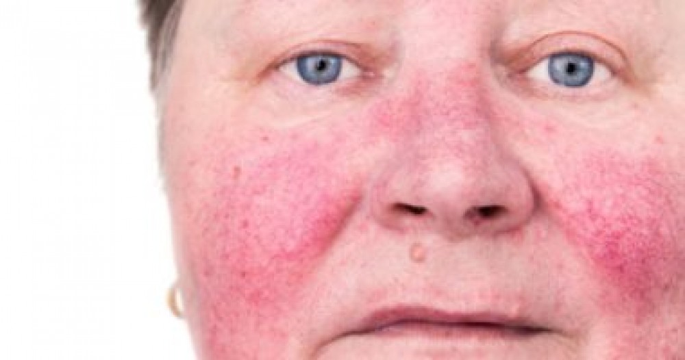 كل ما تريد معرفته عن الوردية الجلدية والعوامل المحفزة وطرق العلاج