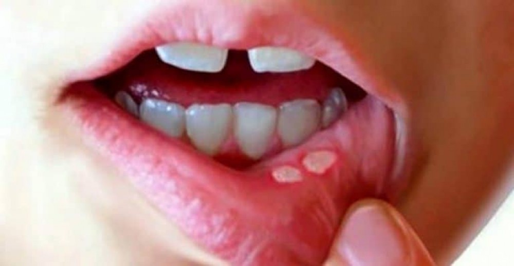 تعرف على طرق منزلية لعلاج فطريات الفم