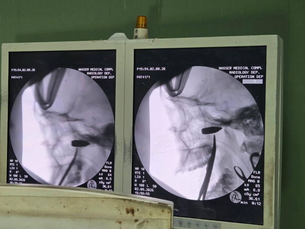 الصحة: نجاح تدخل جراحي بمجمع ناصر باستخراج طلق ناري من فك شابة
