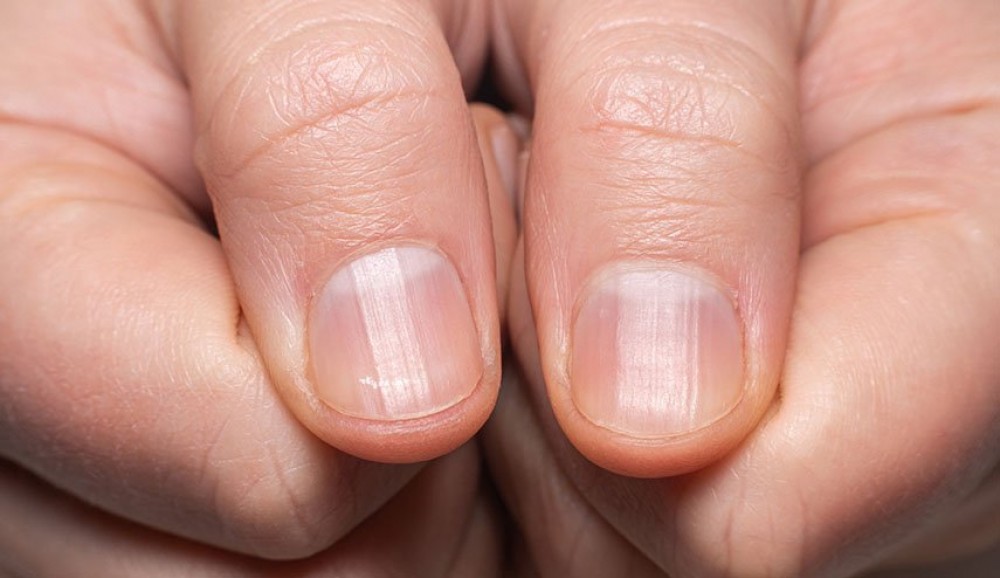 تحذير.. خطوط الأظافر دليل على مشكلة صحية