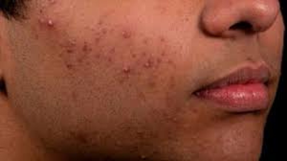 مضاعفات قد تأتي مع حب الشباب.. نصائح صحية للوقاية والعلاج