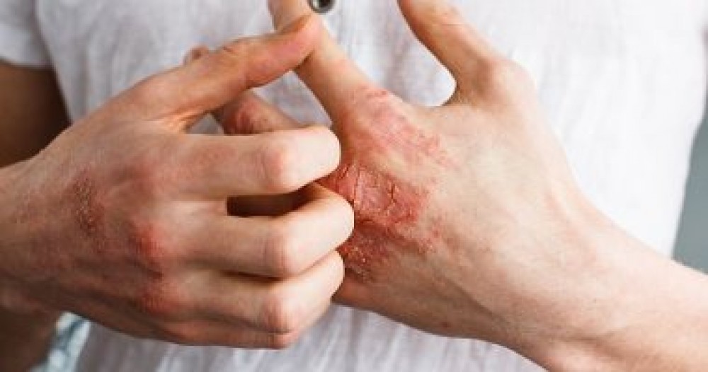 اختلافات في جين معين مسئولة عن الإصابة بالإكزيما