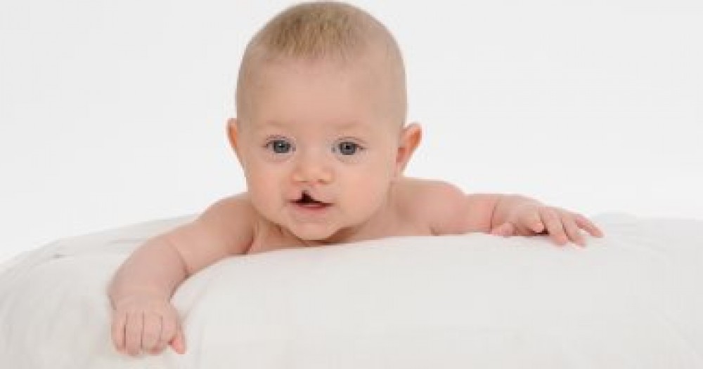كل ما تريد معرفته عن الشفة الأرنبية من أعراض ومضاعفات