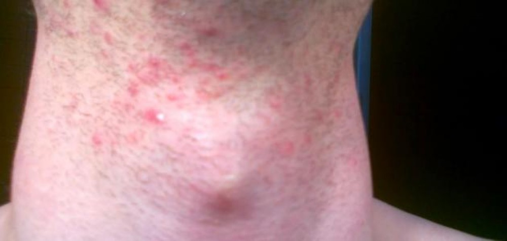 اعرف أسباب ظهور حب الشباب على الرقبة وكيفية علاجه