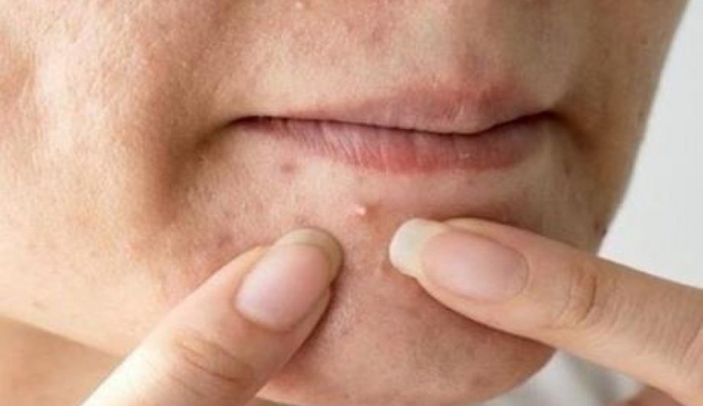 عصر حبوب الوجه يؤدي إلى عواقب وخيمة