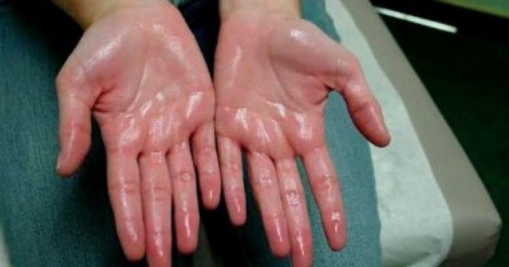 طرق لتفادى مشكلة تعرق اليدين