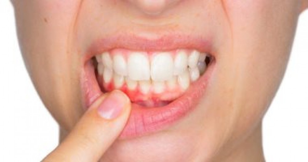 هل تزيد بكتيريا الفم من خطر الإصابة بأمراض القلب؟