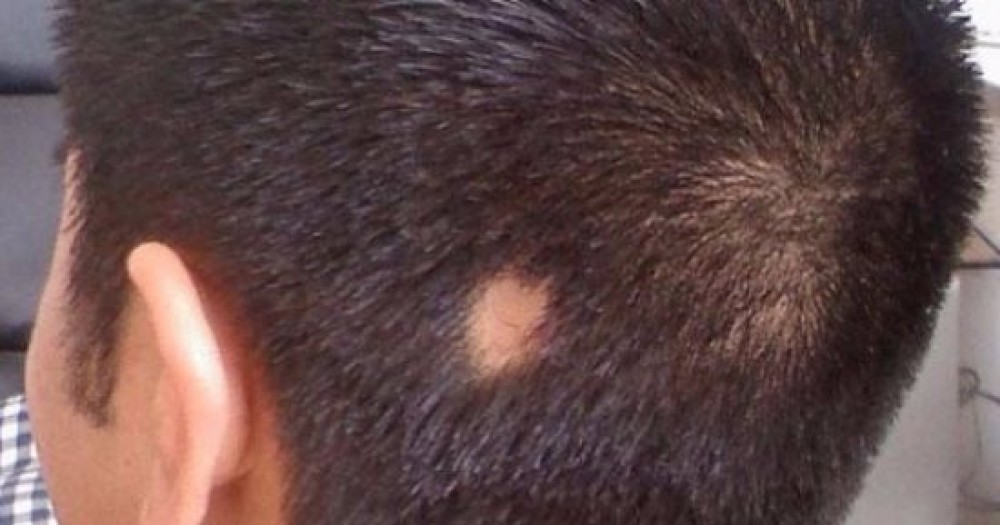أسباب الإصابة بمرض الثعلبة.. وطرق الوقاية منه