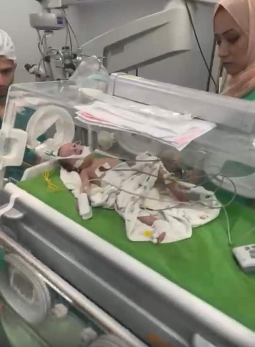 مستشفى العيون ينجح بإجراء تدخل علاجي بالليزر لطفلة (خداج) 