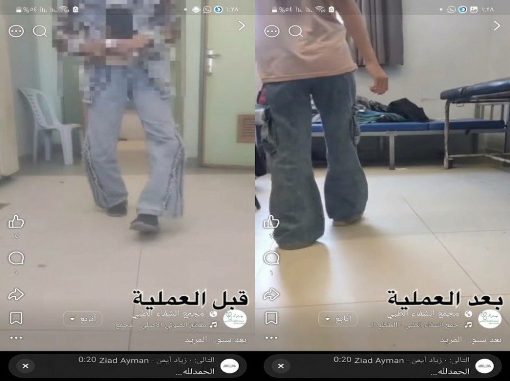 نجاح جراحي بمجمع الشفاء ينهي تقوس ساقي طفلة