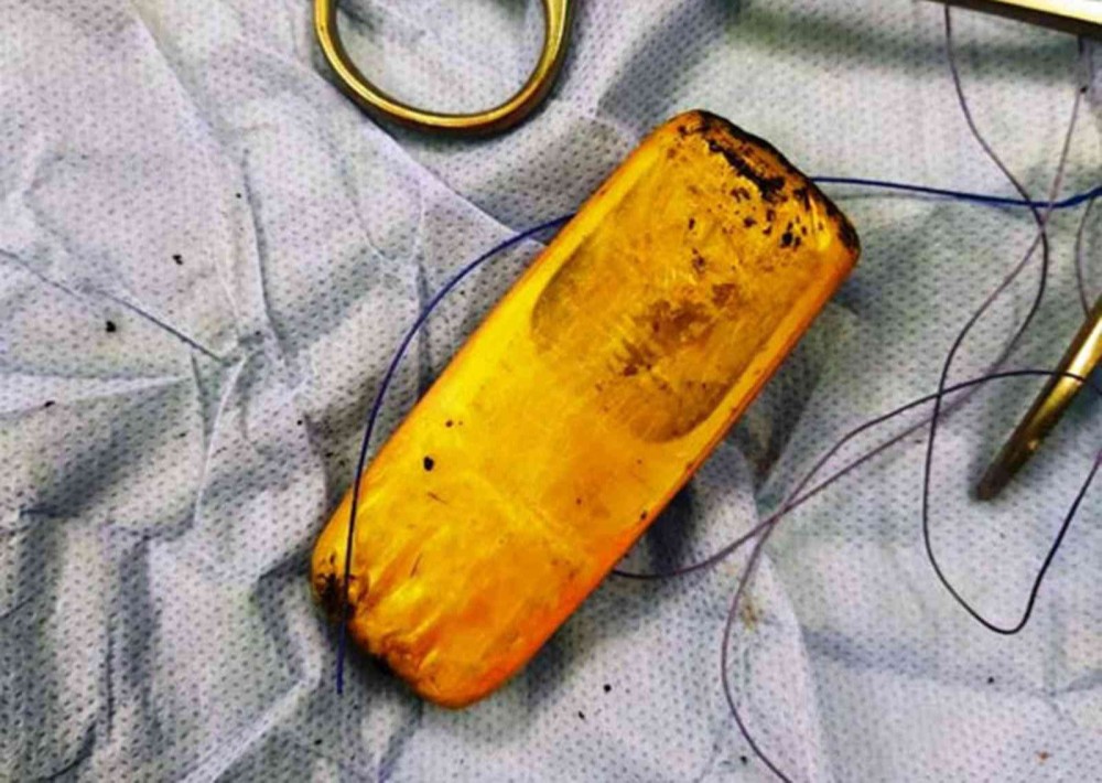 العثور على هاتف محمول في معدة مواطن مصري