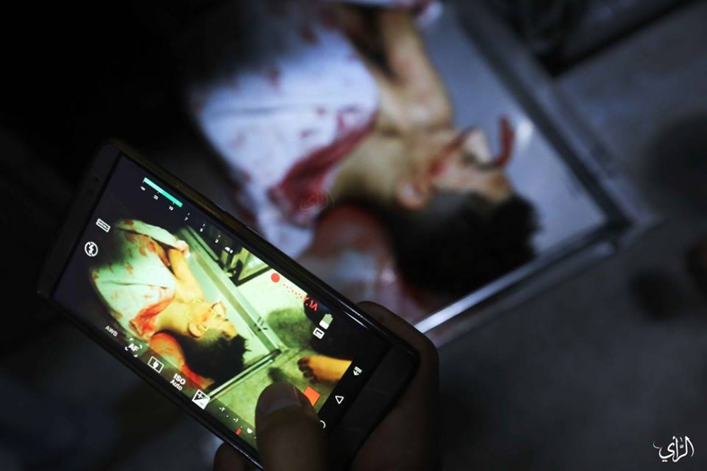 #صور للطفلين أمير النمرة ولؤي كحيل بمشفى الشفاء عقب استشهادهما بقصف الاحتلال لمبنى الكتيبة