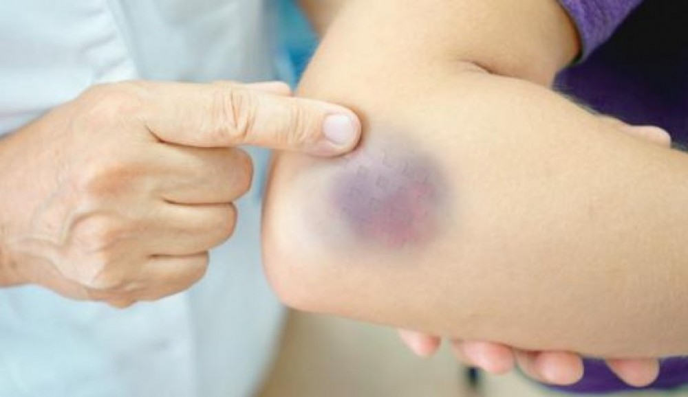 أسباب الكدمات المفاجئة في الجسم