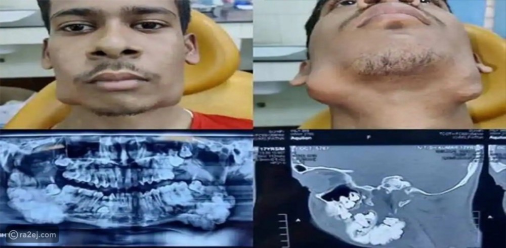 مراهق هندي يعاني من وجود 82 سناً إضافية في فمه