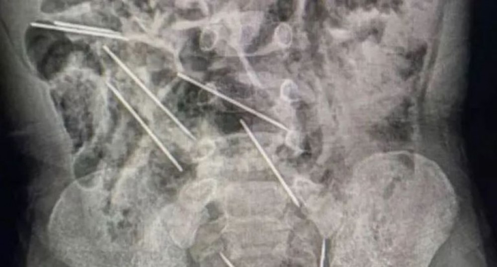 135-151824-child-swallows-injection-needles-2