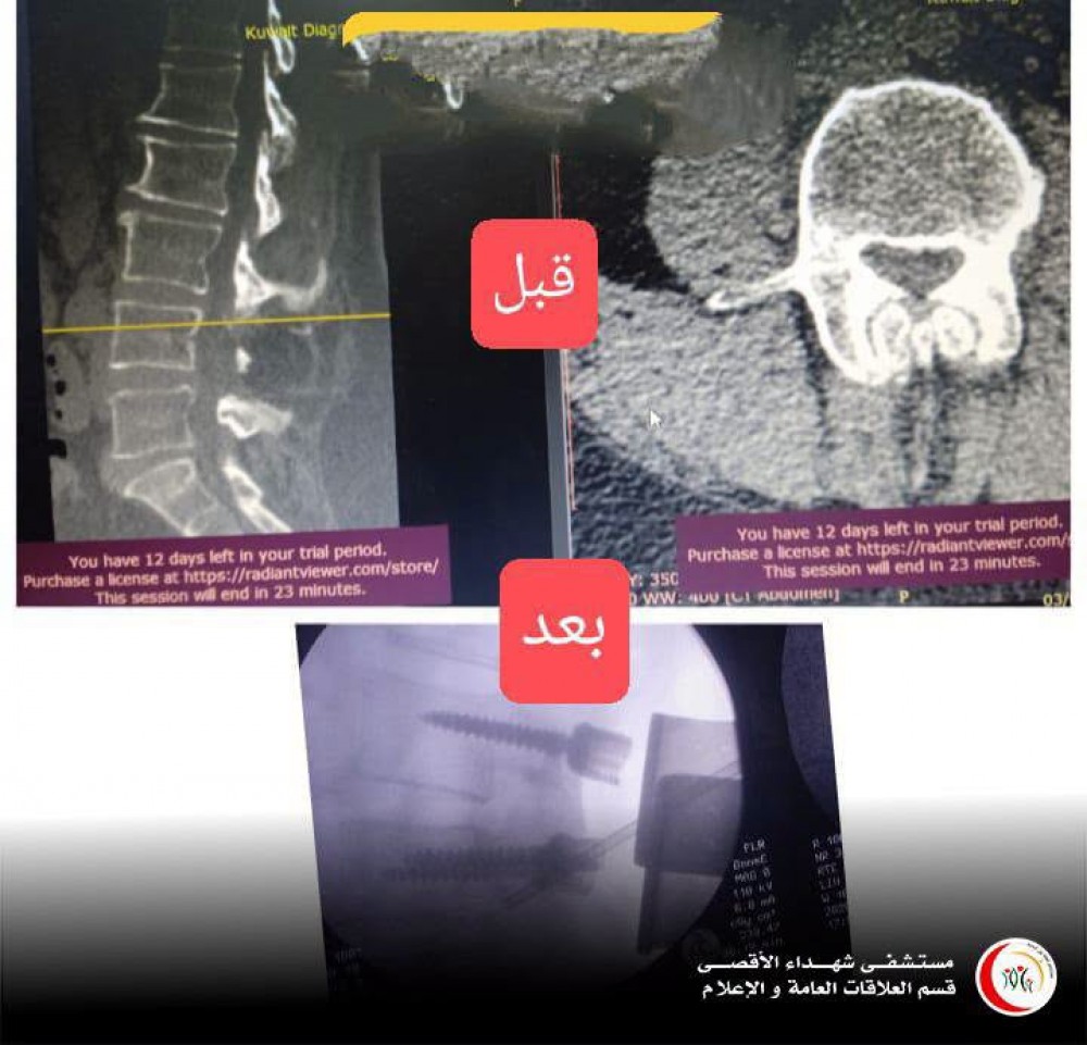  إجراء 12 عملية جراحية معقدة للعمود الفقري في مستشفى شهداء الأقصى