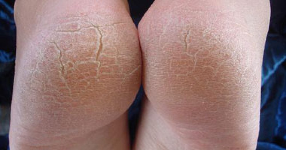 علاج تشقق الكعبين.. 6 وصفات منزلية فعالة منها غسول الفم والعسل
