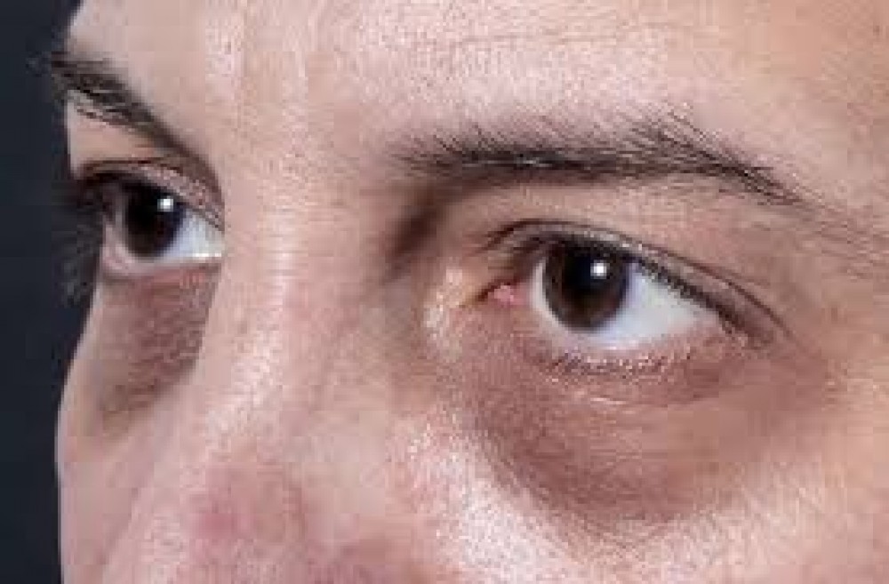 أمراض تشير إليها الهالات السوداء تحت العينين