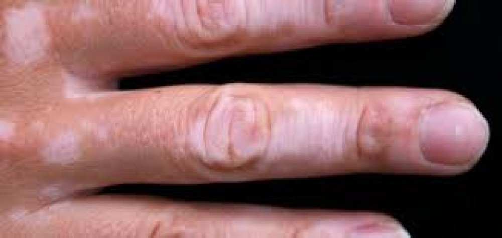تعرف على أنواع مختلفة من اضطرابات صبغة الجلد ونصائح لعلاجها