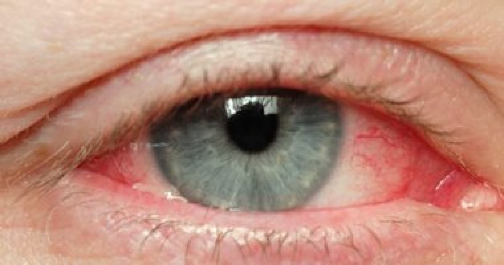 تعرف على طرق علاج التهاب جفون العين