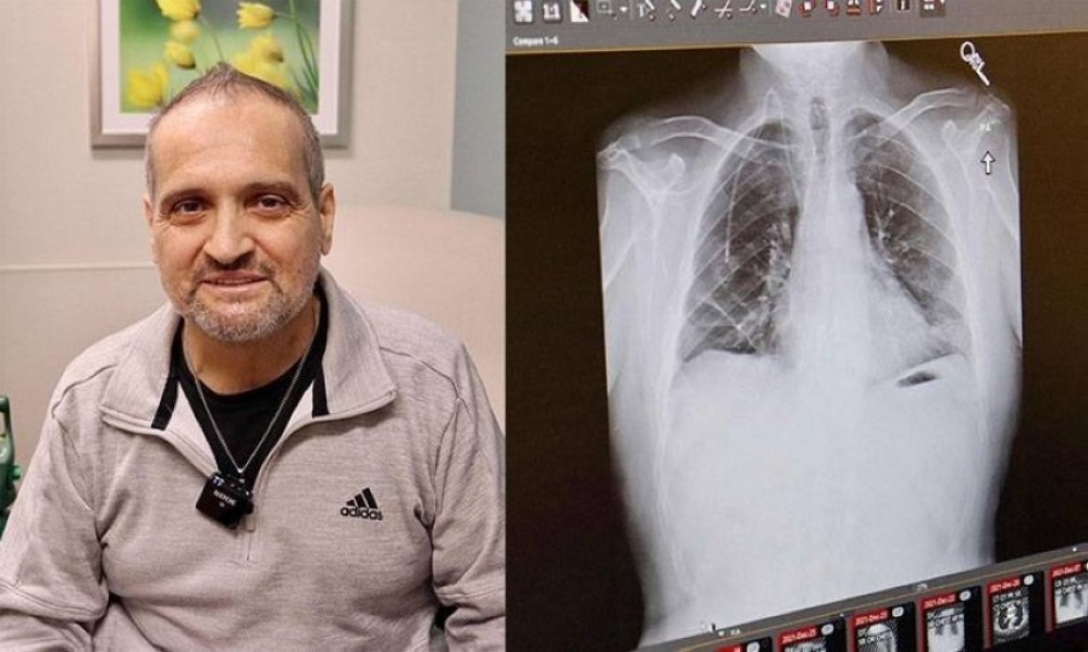 عملية زرع مزدوجة لرئتين لدي مصاب بالسرطان