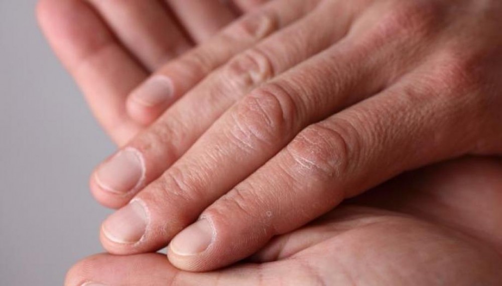 هل تعاني من جفاف اليدين؟.. تعرف على الأسباب وطرق العلاج